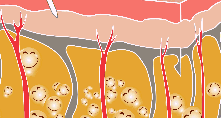 艾米丽程红涛吸脂瘦腿吸脂专业吗？