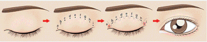 北京爱悦丽格马力：做双眼皮术前术后要注意哪些？