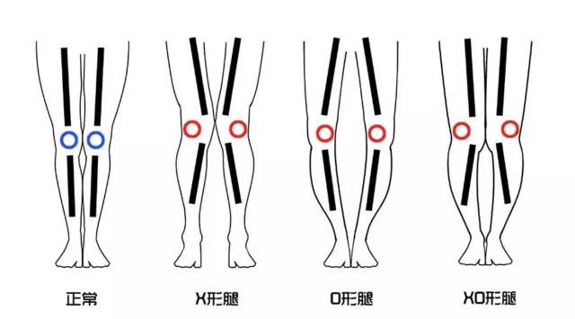 怎么判断O型腿和X型腿？达人告诉你原因及矫正方式！